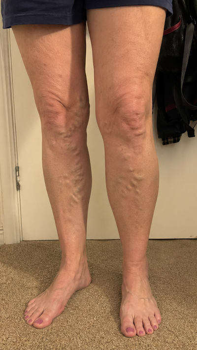 Before - Cindy